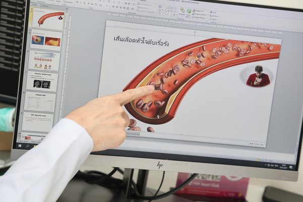 Coronary Artery Calcium Scoring Cause Coronary Artery Risk Disease Heart Failure